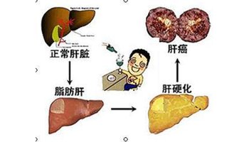 肝结石