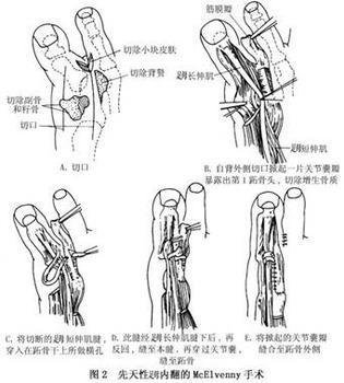 前臂石膏,上肢肩人字形石膏,小腿石膏,大腿石膏,下肢髋人字形石膏等等