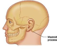 乳突炎